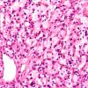 4B1 Hemangioblastoma (Case 4) H&E 4