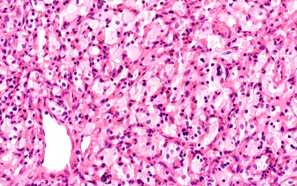 4B1 Hemangioblastoma (Case 4) H&E 4