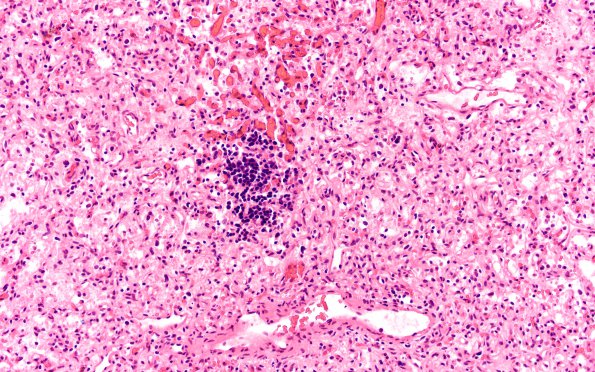 4B2 Hemangioblastoma (Case 4) H&E 5 EMH