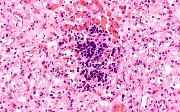 4B3 Hemangioblastoma (Case 4) H&E 5 EMH 2