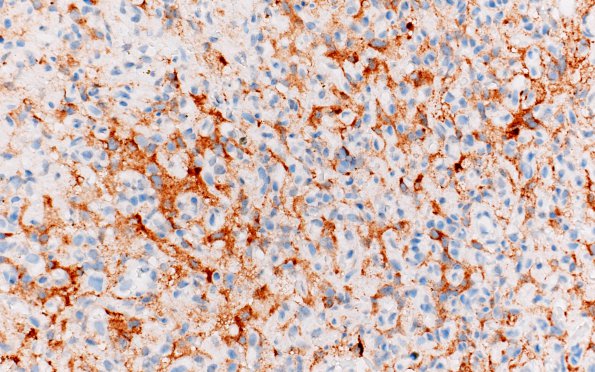 4C Hemangioblastoma (Case 4) inhibin 2