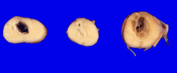 5A1 Syringobulbia & Syringomyelia & Hemangioblastoma (Case 5) 2