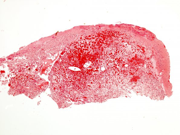 6A1 Hemangioblastoma (Case 6) H&E 4