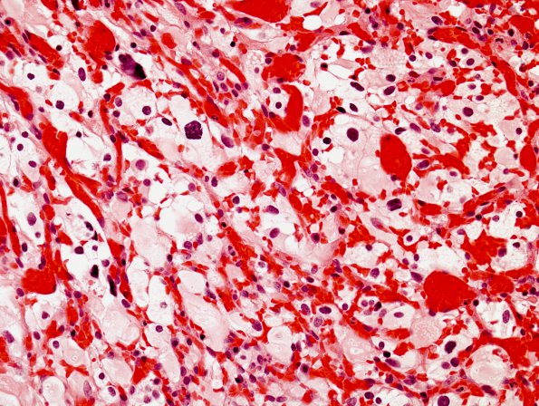 6A2 Hemangioblastoma (Case 6) H&E 3