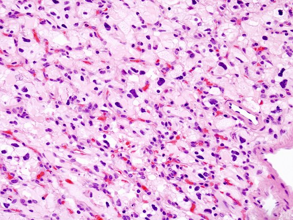 6A3 Hemangioblastoma (Case 6) H&E 2