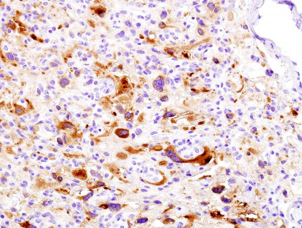 6B1 Hemangioblastoma (Case 6) Inhibin  foamy 2