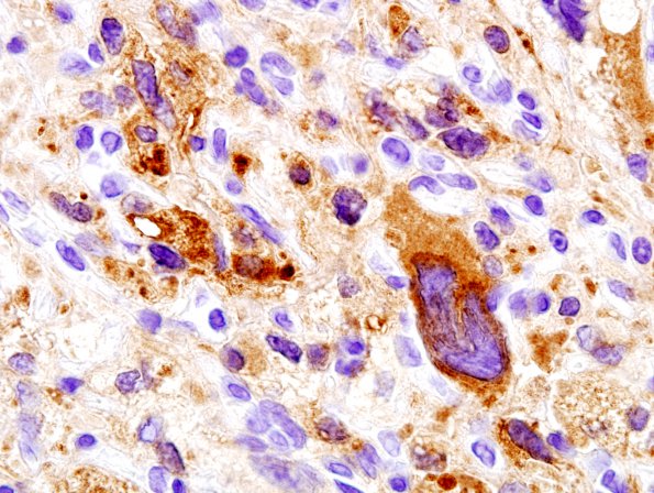 6B2 Hemangioblastoma (Case 6) Inhibin 9