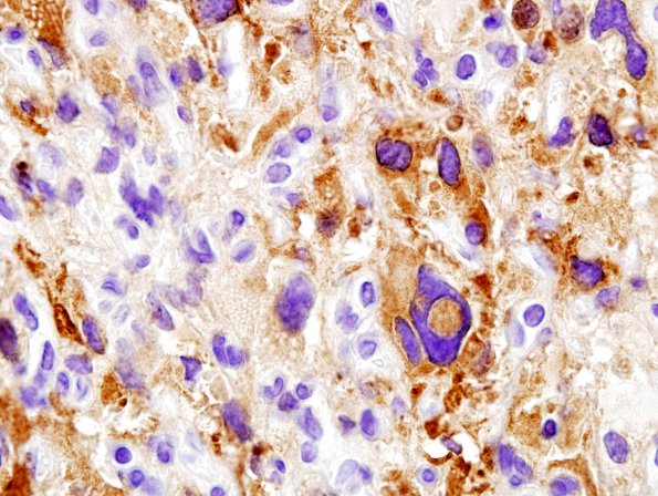 6B3 Hemangioblastoma (Case 6) Inhibin 10