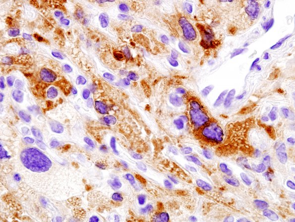 6B4 Hemangioblastoma (Case 6) Inhibin foamy