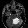 7A Hemangioblastoma (Case 7) T2 1 - Copy