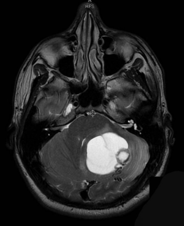 7A Hemangioblastoma (Case 7) T2 1 - Copy