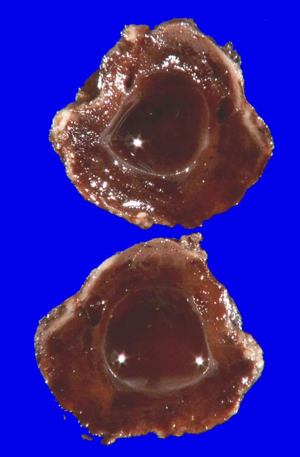 7B Hemangioblastoma (Case 7) 3