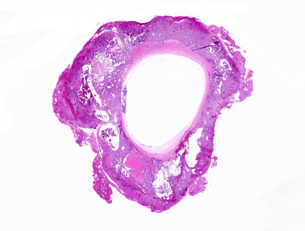 7C1 Hemangioblastoma (Case 7) H&E whole mount