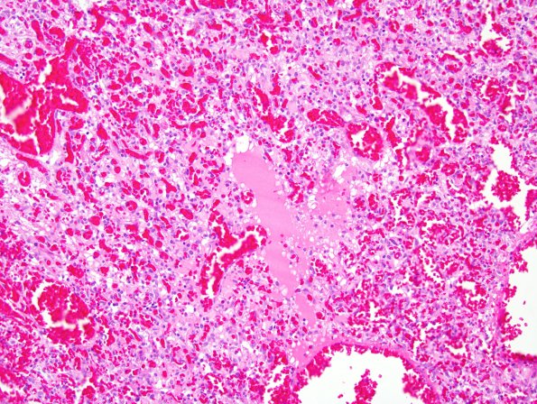 7C2 Hemangioblastoma (Case 7) H&E 2.jpg