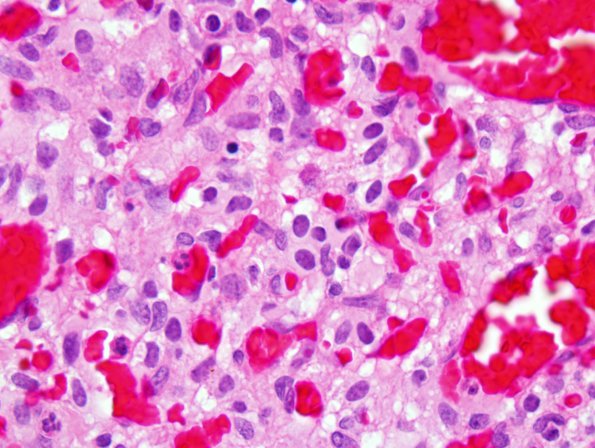 7C3 Hemangioblastoma (Case 7) H&E 3.jpg