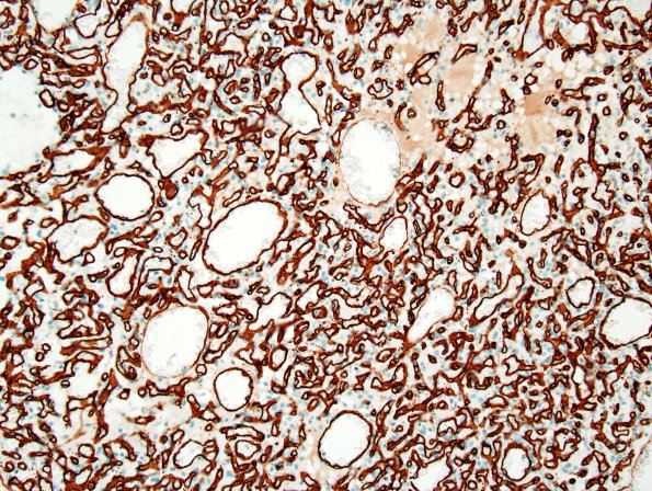 7D2 Hemangioblastoma (Case 7) CD34 2.jpg