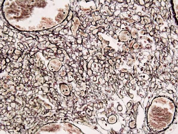 7E Hemangioblastoma (Case 7) Retic 1.jpg