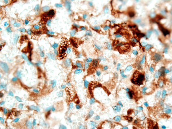 7G Hemangioblastoma (Case 7) S-100 1.jpg