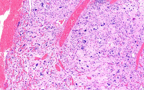 8A1 Hemangioblastoma (Case 8) H&E 10X 2