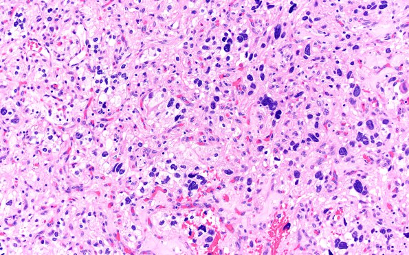 8A2 Hemangioblastoma (Case 8) H&E 20X 2