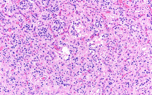 8A3 Hemangioblastoma (Case 8) H&E 20X 1