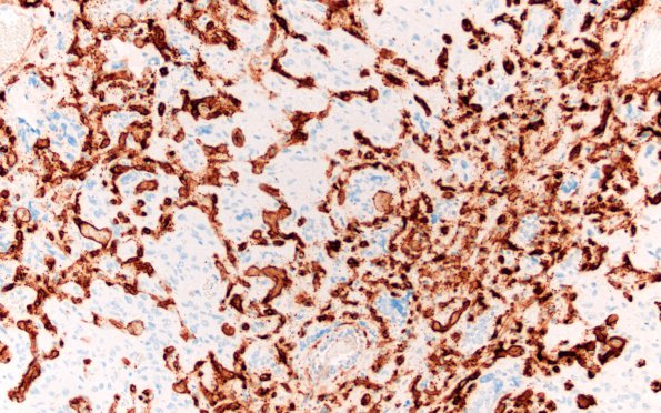 8B1 Hemangioblastoma (Case 8) CD34 20X 1