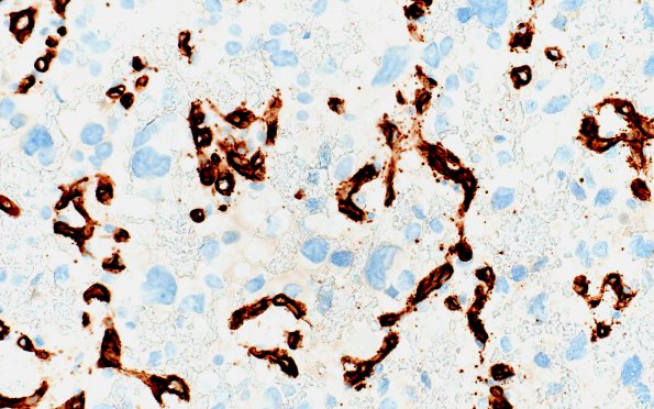 8B2 Hemangioblastoma (Case 8) CD34 40X 2