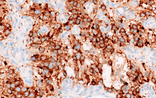 8C Hemangioblastoma (Case 8) Inhibin 40X 1