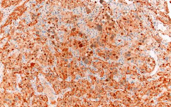 8D Hemangioblastoma (Case 8) S100 20X 2