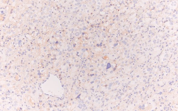 8F Hemangioblastoma (Case 8) PAX-8 20X 2