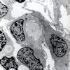 9A1 Hemangioblastoma (Case 9) EM 1 - Copy