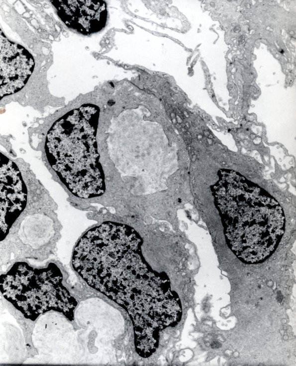 9A1 Hemangioblastoma (Case 9) EM 1 - Copy