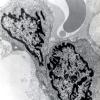 9A2 Hemangioblastoma (Case 9) EM 2 - Copy