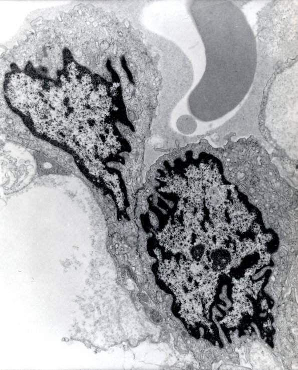 9A2 Hemangioblastoma (Case 9) EM 2 - Copy