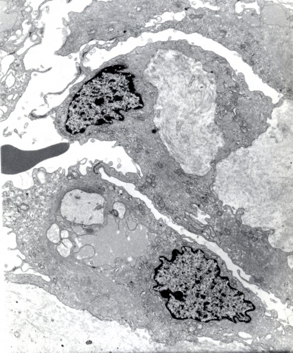 9A3 Hemangioblastoma (Case 9) EM 3 - Copy