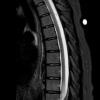 1A1 Spine STIR A - Copy