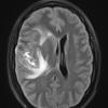 1A1 Primary Intracranial Sarcoma Dicer1 mutant (Case 1) TIRM Blade R - Copy