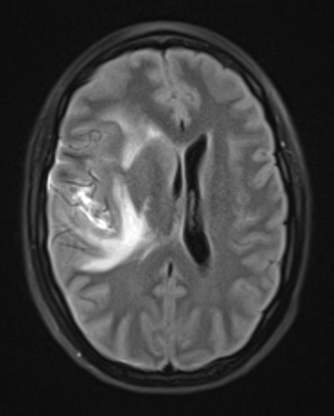 1A1 Primary Intracranial Sarcoma Dicer1 mutant (Case 1) TIRM Blade R - Copy