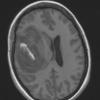 1A2 Primary Intracranial Sarcoma Dicer1 mutant (Case 1) T1 noC 1 - Copy