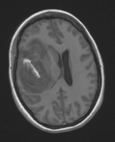 1A2 Primary Intracranial Sarcoma Dicer1 mutant (Case 1) T1 noC 1 - Copy