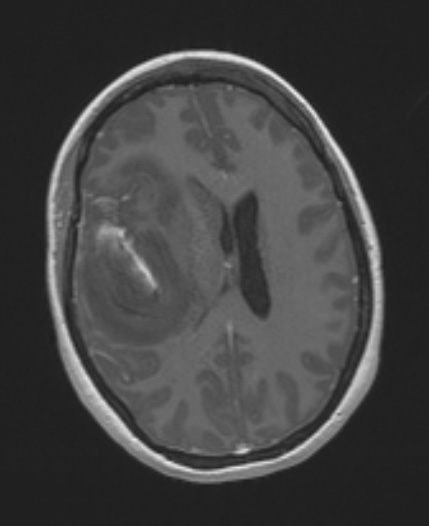 1A3 Primary Intracranial Sarcoma Dicer1 mutant (Case 1) T1W 1 - Copy