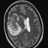 1A4 Primary Intracranial Sarcoma Dicer1 mutant (Case 1) T2W 1 - Copy