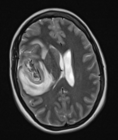 1A4 Primary Intracranial Sarcoma Dicer1 mutant (Case 1) T2W 1 - Copy