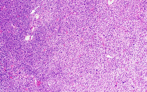 1B1 Primary Intracranial Sarcoma, Dicer 1 Mutant (Case 1) H&E 10X 3 copy