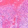 1B10 Primary Intracranial Sarcoma, Dicer 1 Mutant (Case 1) H&E 40X 8