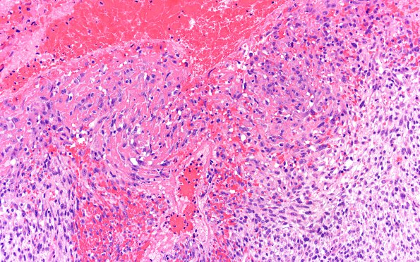 1B10 Primary Intracranial Sarcoma, Dicer 1 Mutant (Case 1) H&E 40X 8