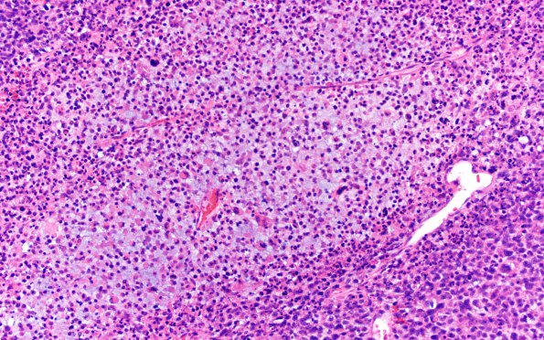 1B12 Primary Intracranial Sarcoma, Dicer 1 Mutant (Case 1) H&E 40X 10