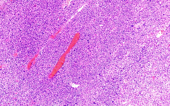 1B2 Primary Intracranial Sarcoma, Dicer 1 Mutant (Case 1) H&E 10X