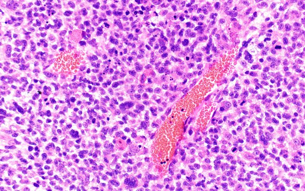 1B3 Primary Intracranial Sarcoma, Dicer 1 Mutant (Case 1) H&E 40X 3