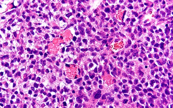 1B4 Primary Intracranial Sarcoma, Dicer 1 Mutant (Case 1) H&E 60X 1